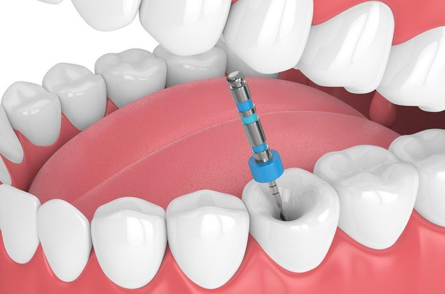 Root Canal Root Canal