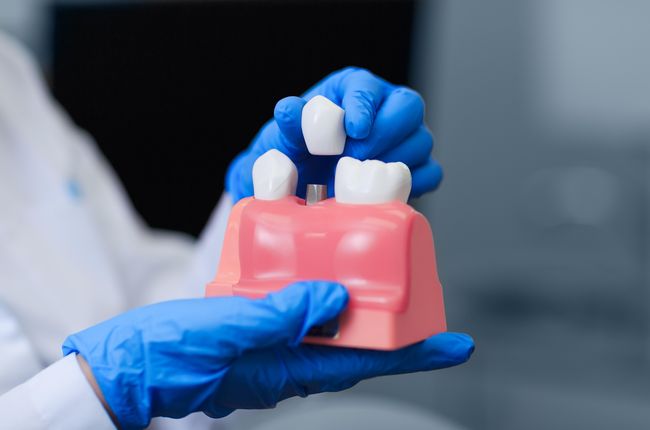 Dental Implants Dental Implants